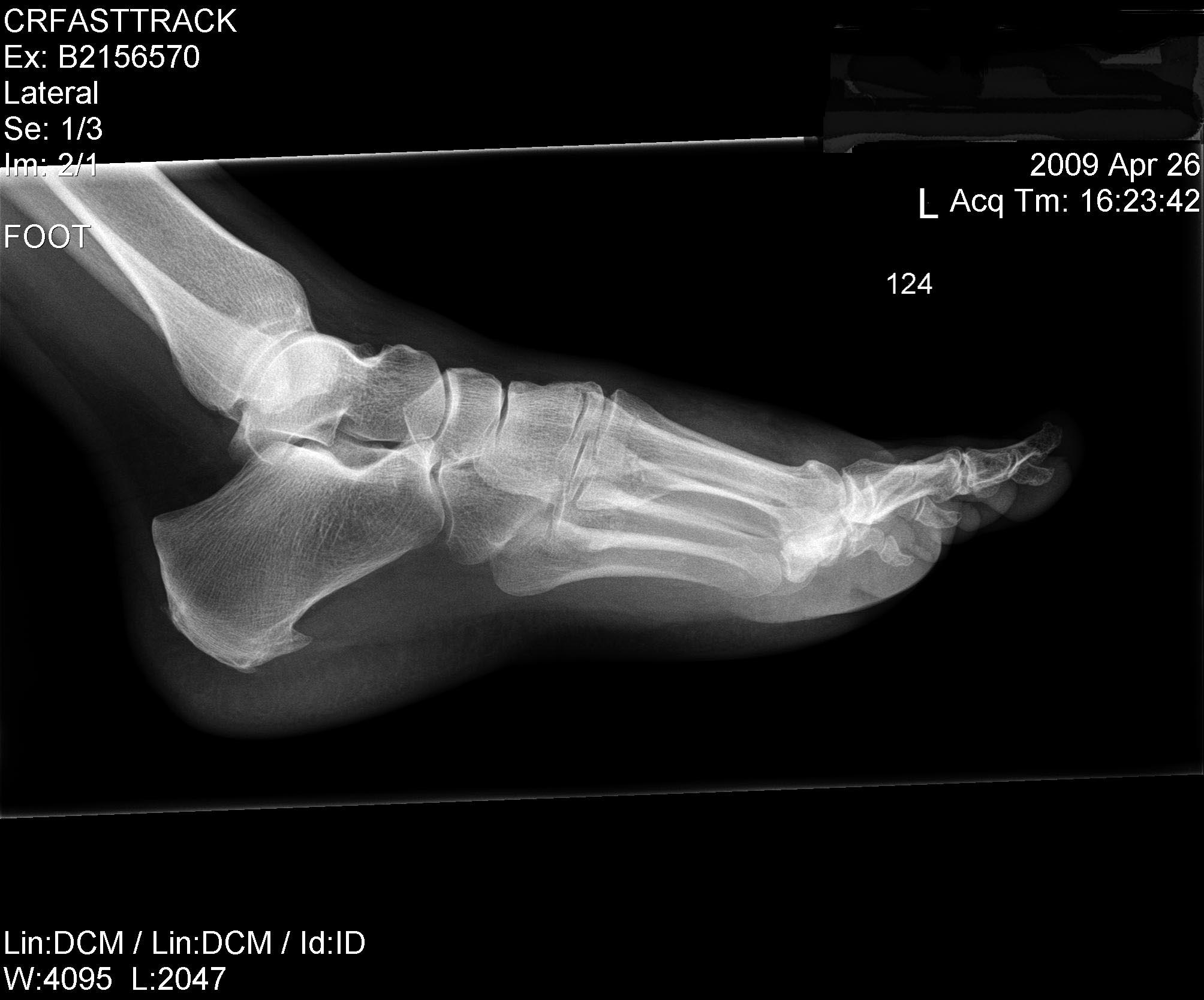 The X-Rays « So You've Got a LISFRANC INJURY!